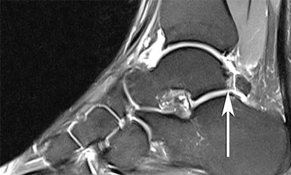 Задний импинджмент синдром голеностопного сустава мрт