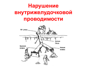 Нарушение внутрижелудочковой проводимости сердца синдром