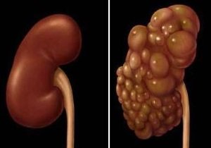 Измененная почка