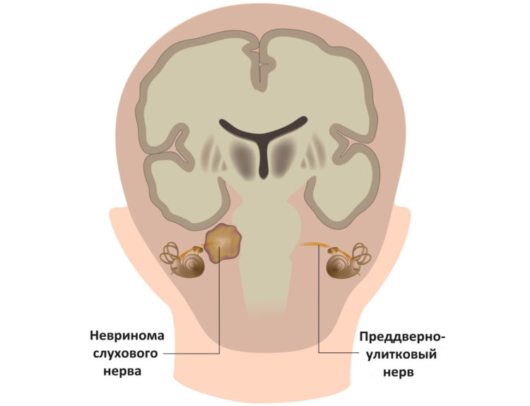 невринома слухового нерва