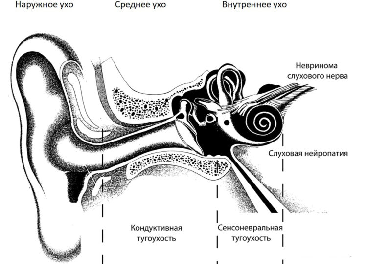 Этиология, симптомы, диагностика и методы лечения невриномы слухового нерва
