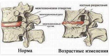 Остеохондроз