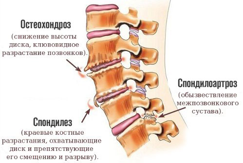 остеохондроз