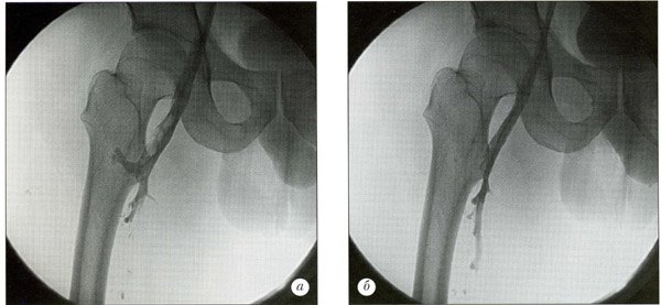 Острый венозный тромбоз бедренной вены