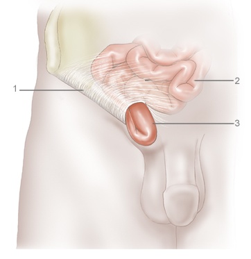 Механизм развития паховой грыжи