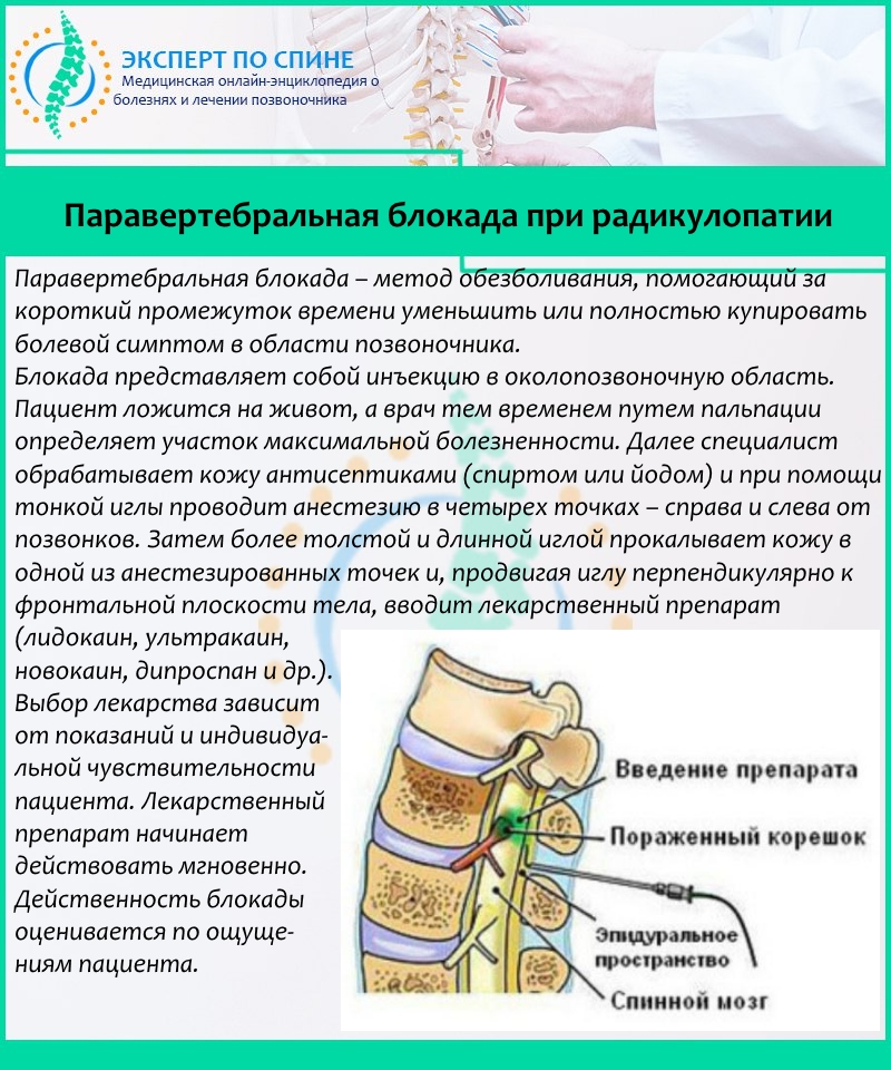 Паравертебральная блокада при радикулопатии