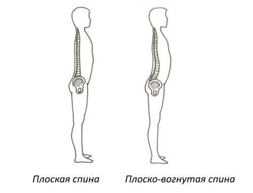 Виды плоской спины