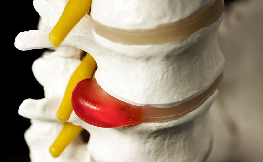 При обострении грыжи межпозвоночного диска требуется оперативное лечение