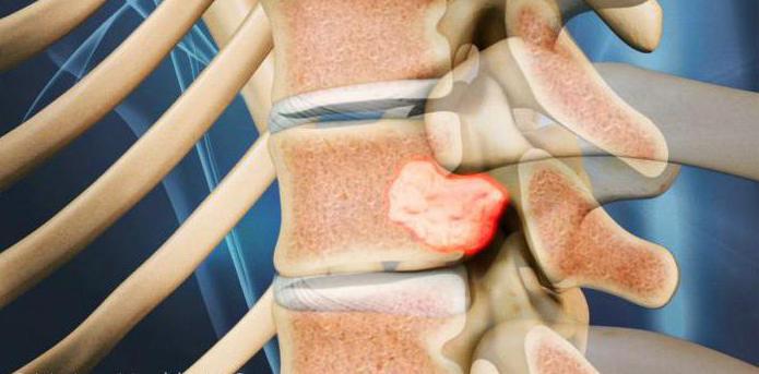 Причиной корешкового синдрома может быть опухоль в позвоночнике