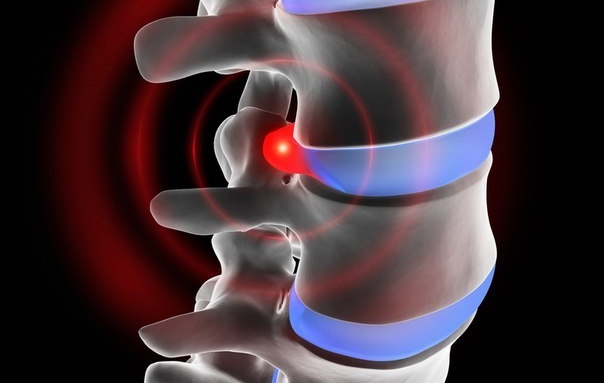 Протрузии и грыжи дисков тоже провоцируют корешковый синдром