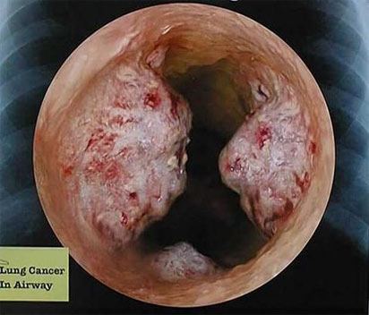 Рак бронхов при бронхоскопии