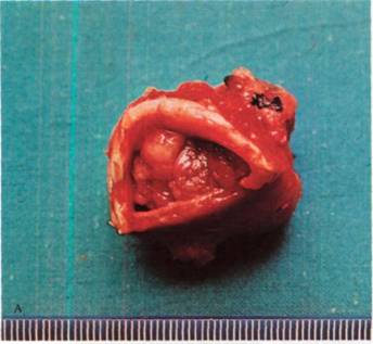 Послеоперационный препарат - рак трахеи