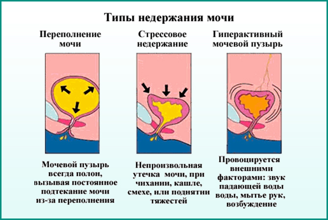 Типы недержания мочи Недержание мочи