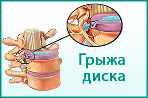 Грыжа межпозвоночного диска Грыжа диска