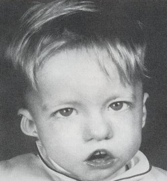 Ребенок со специфическими чертами, характерными для синдрома Ди Джорджи синдром Ди Джорджи