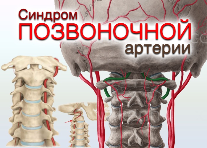 синдром позвоночной артерии