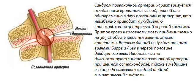 сдавливание позвоночной артерии