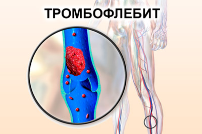 Тромбофлебит Образование тромбов