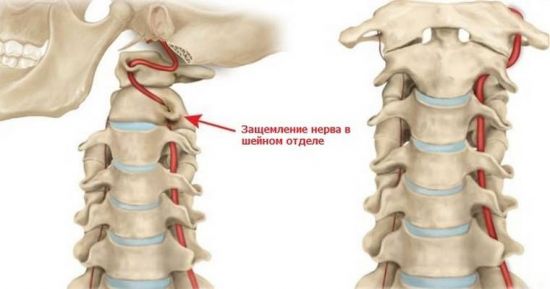 Защемление нерва в позвоночнике
