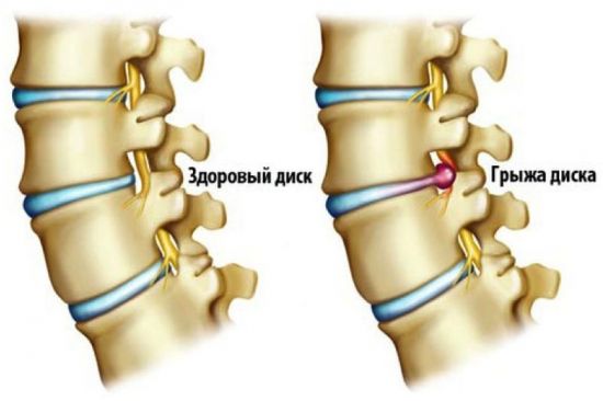 Грыжа позвоночного диска