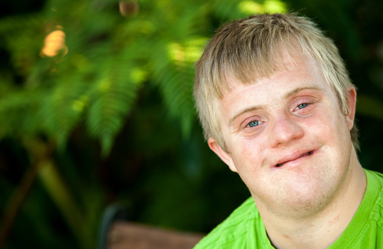 Синдром Дауна