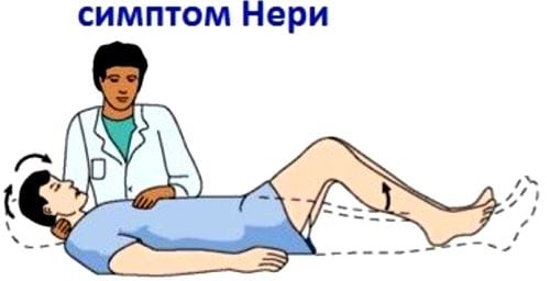 Что такое остеохондроз корешкового синдрома