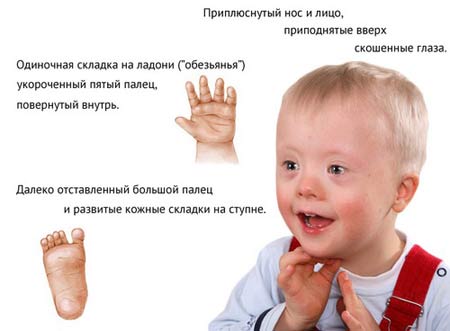 Симптомы синдрома Дауна