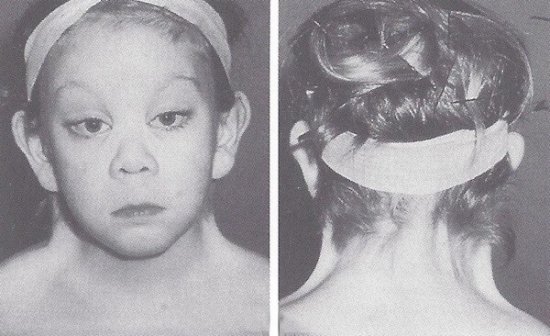 Синдром Шерешевского-Тернера