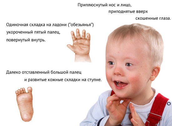 Симптомы синдрома Дауна Симптомы синдрома Дауна