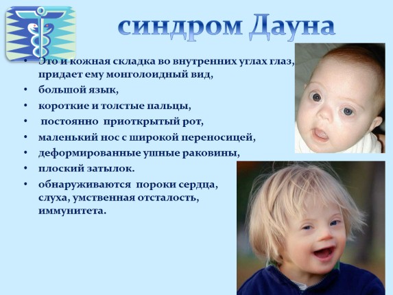 Признаки синдрома Дауна