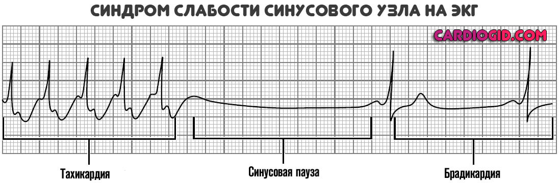 синдром-слабости-синусового-узла-на-экг