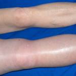 Мигрирующий тромбофлебит: симптомы и лечение