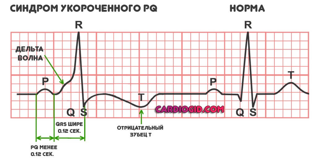 синдром укороченного PQ на ЭКГ