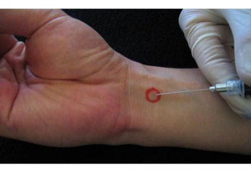 Укол в область запястного канала