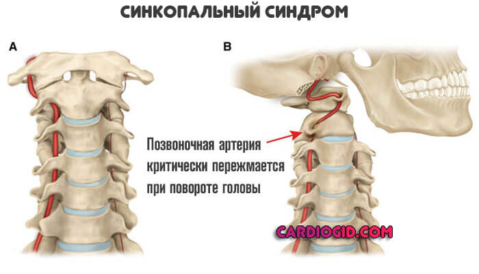 синкопальный синдром