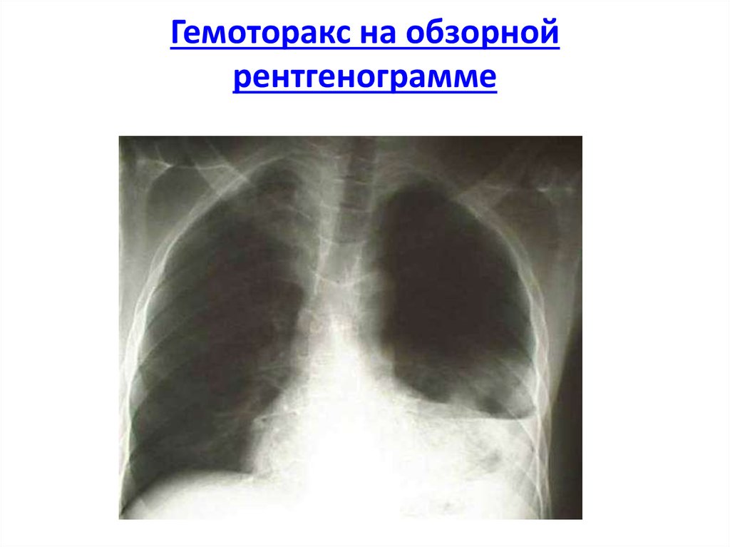 Код мкб проникающее ранение грудной клетки