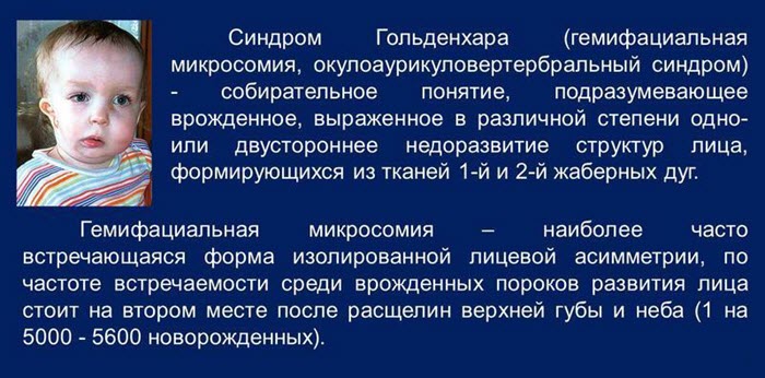 Определение синдрома Гольденхара