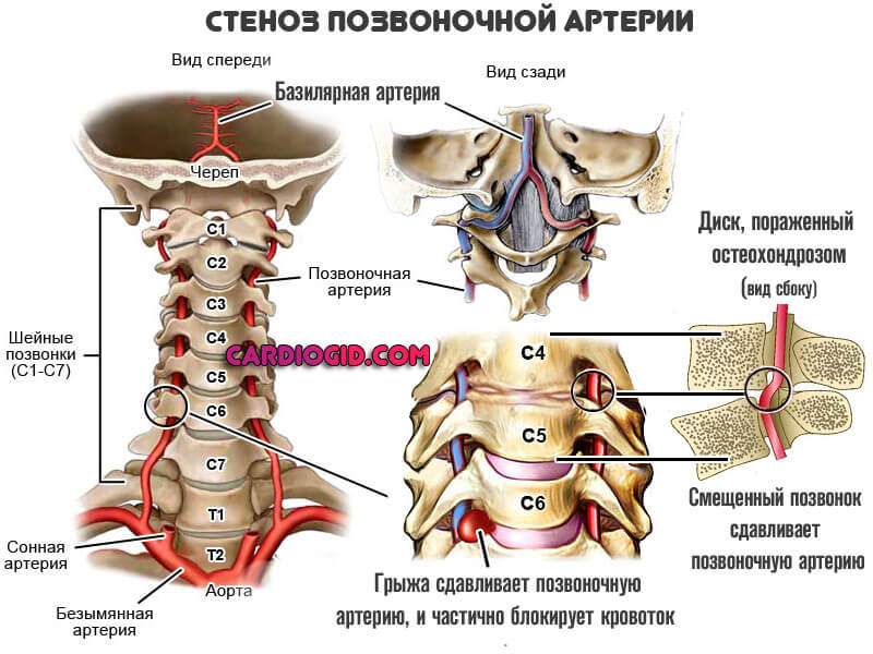 стеноз позвоночной артерии