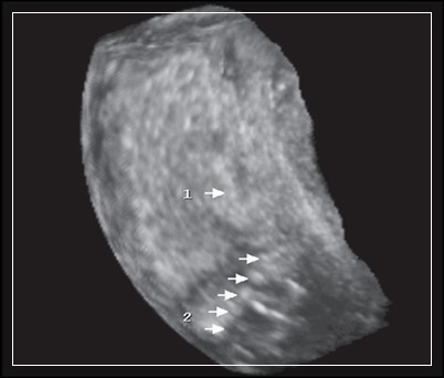Субинволюция матки на УЗИ