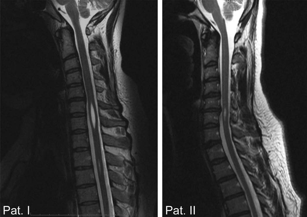 Синдром фиксированного спинного мозга у ребенка