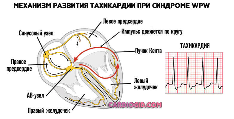 тахикардия-при-синдром-впв