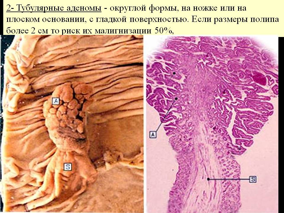 Тубулярная аденома