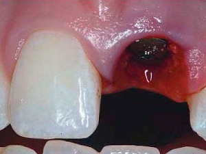 Удаленный зуб