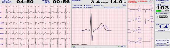 Синдром укороченного интервала pq по мкб 10
