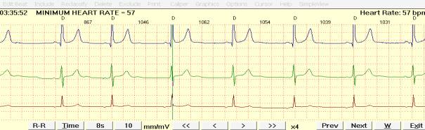 Синдром укороченного интервала pq по мкб 10