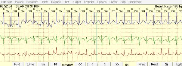 Синдром укороченного интервала pq по мкб 10