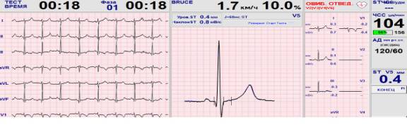 Синдром укороченного интервала pq по мкб 10