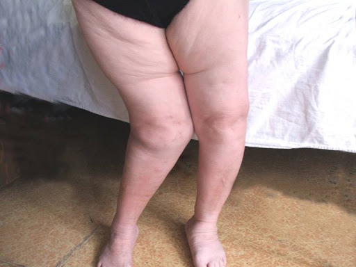 Синдром фиксированного спинного мозга у ребенка