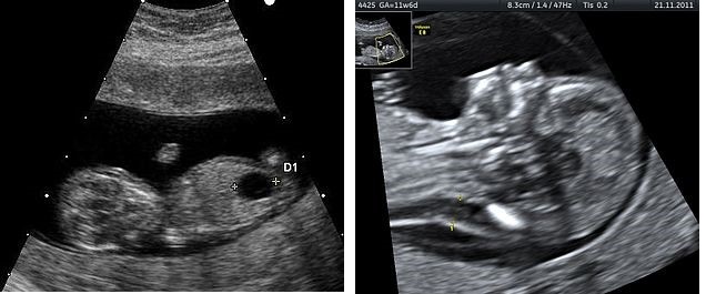 признаки узи