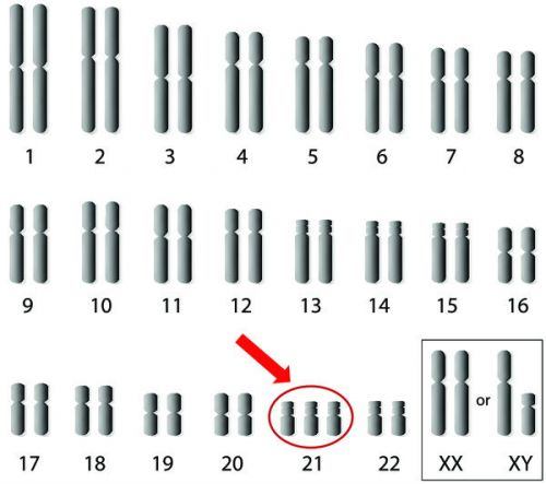 Аномалия 21 хромосомы